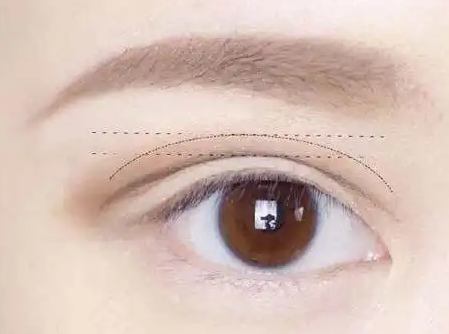 双眼皮