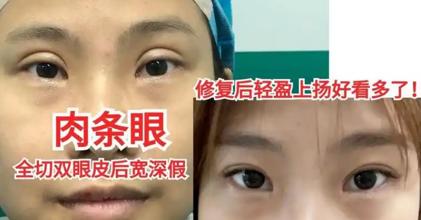 双眼皮