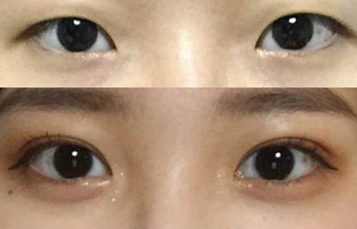 双眼皮
