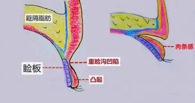 双眼皮