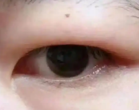 双眼皮