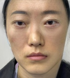 去眼袋手术