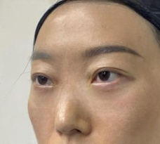 去眼袋手术