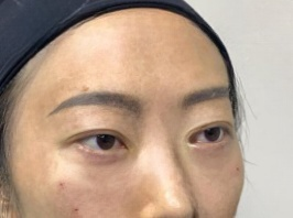 去眼袋手术
