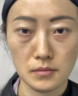 去眼袋手术