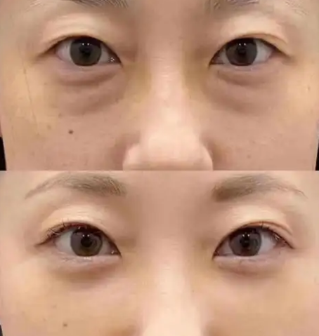 眼袋