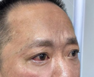 去眼袋手术