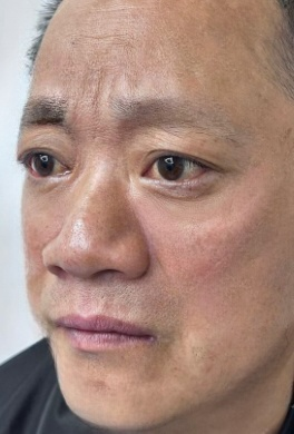 去眼袋手术