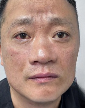 去眼袋手术