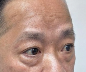去眼袋手术