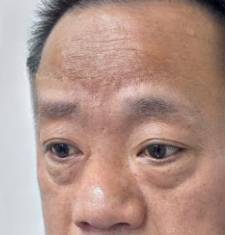 去眼袋手术