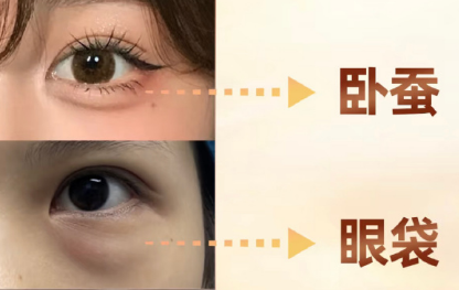 去眼袋手术