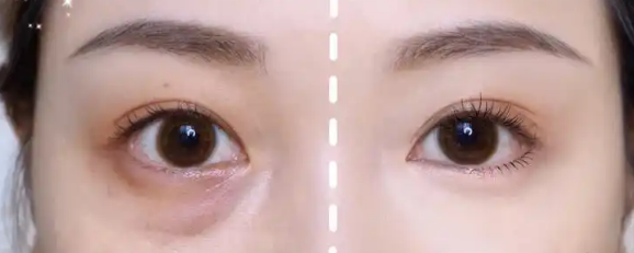 眼袋