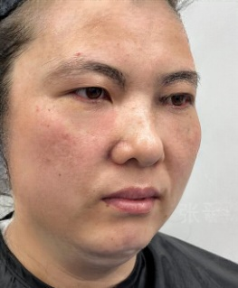 去眼袋手术