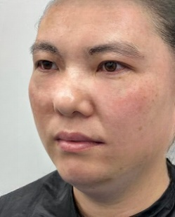 去眼袋手术