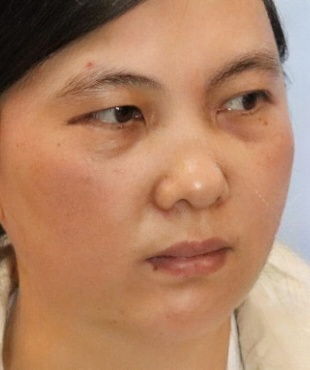 去眼袋手术