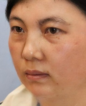 去眼袋手术