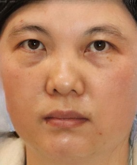 去眼袋手术
