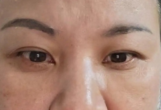 去眼袋手术