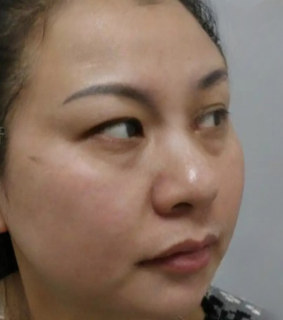 去眼袋手术