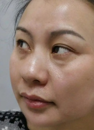 去眼袋手术