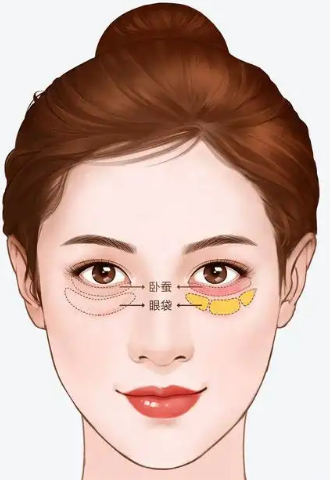 去眼袋手术
