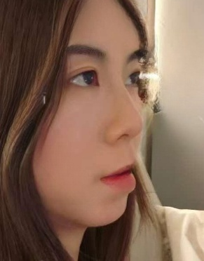 去眼袋手术