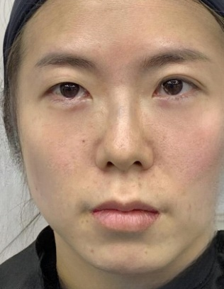 去眼袋手术