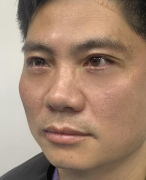 去眼袋手术