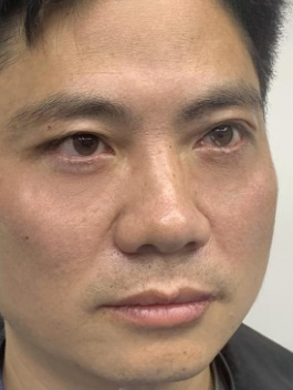 去眼袋手术