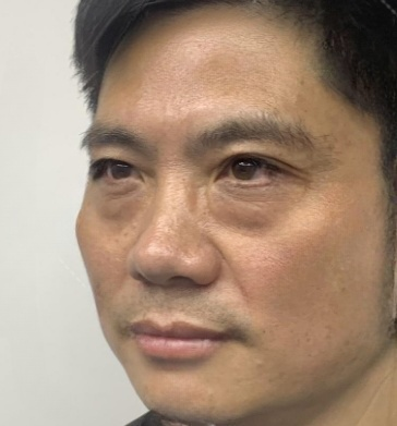 去眼袋手术