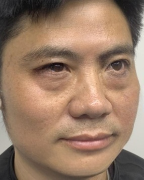 去眼袋手术