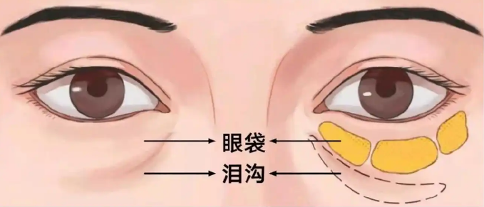去眼袋手术