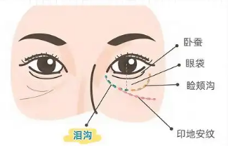 去眼袋手术