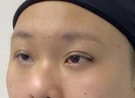 去眼袋手术