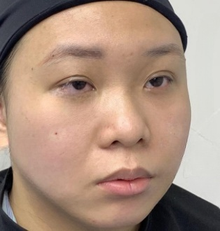去眼袋手术