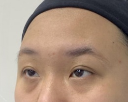去眼袋手术