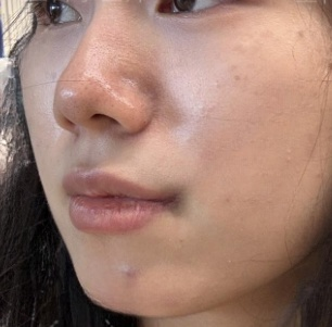 去眼袋手术