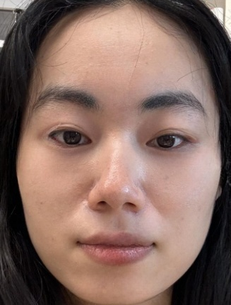 去眼袋手术