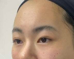 去眼袋手术