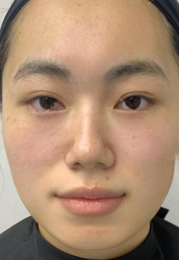 去眼袋手术
