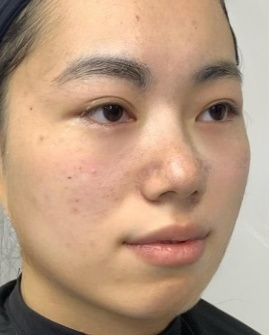 去眼袋手术