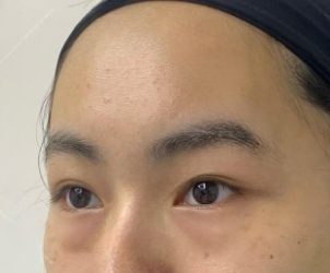去眼袋手术