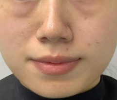 去眼袋手术