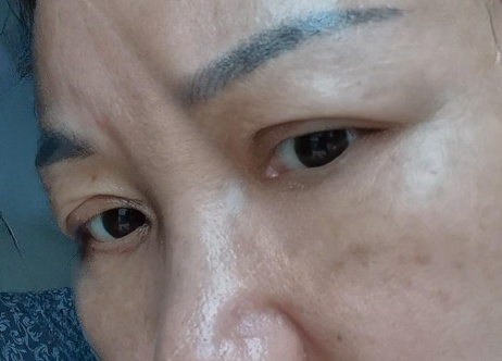去眼袋手术