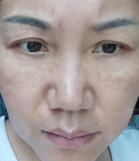 去眼袋手术