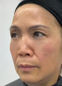 去眼袋手术