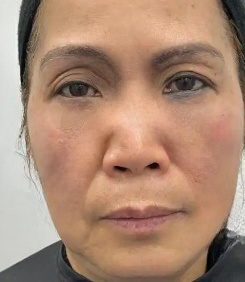 去眼袋手术