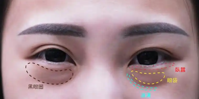 眼袋