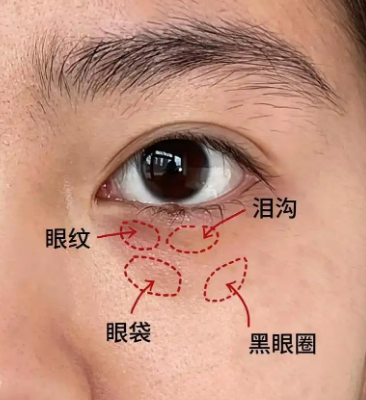 眼袋